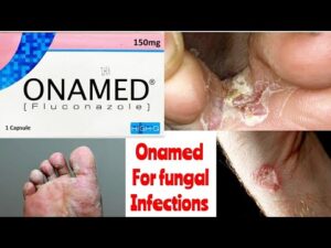 ONAMED 150MG